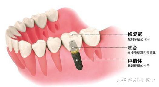 种植一颗牙齿多少钱一个